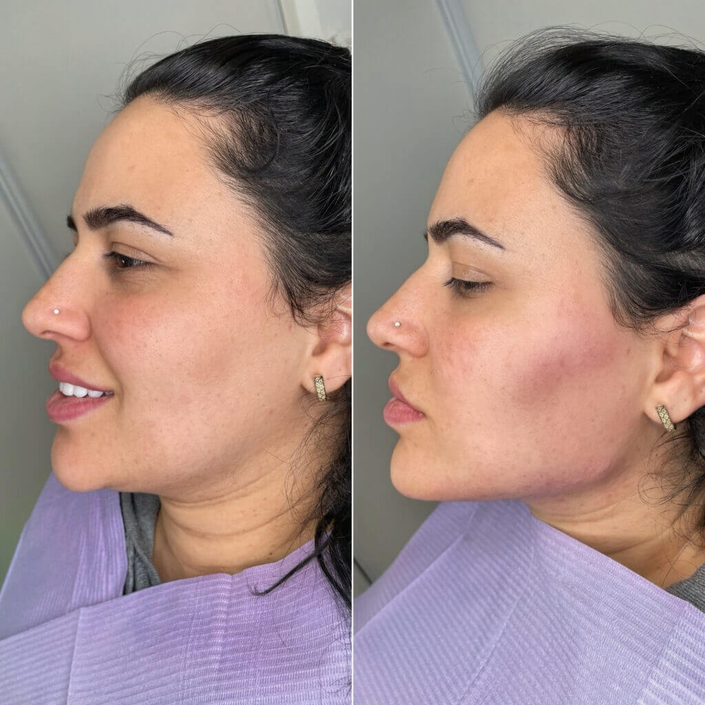 Perfil facial en dos fotografías con distinta posición de los labios.