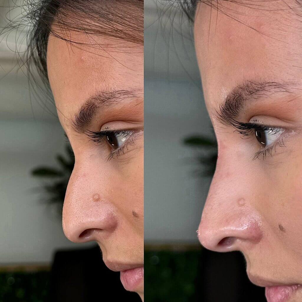 Tratamiento de limpieza facial con resultados visibles