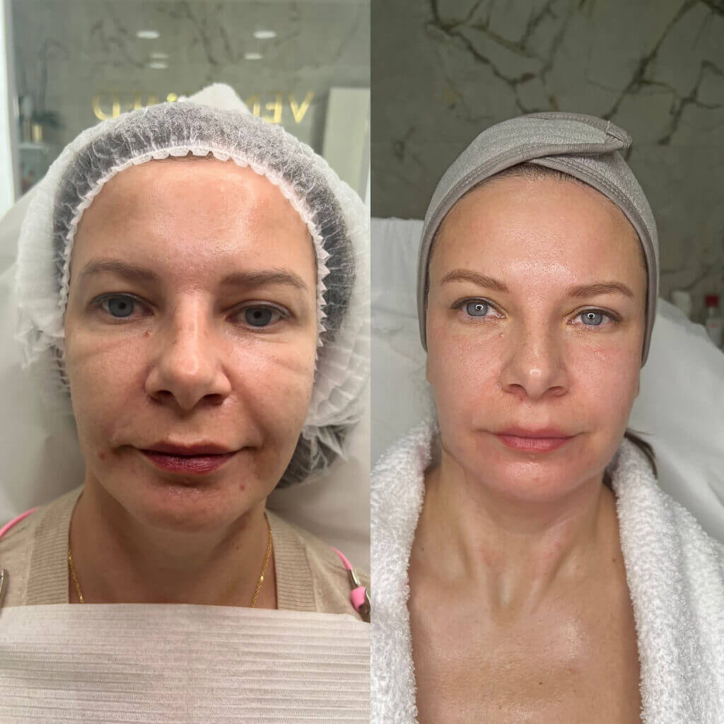 Rostro renovado y fresco después de limpieza facial