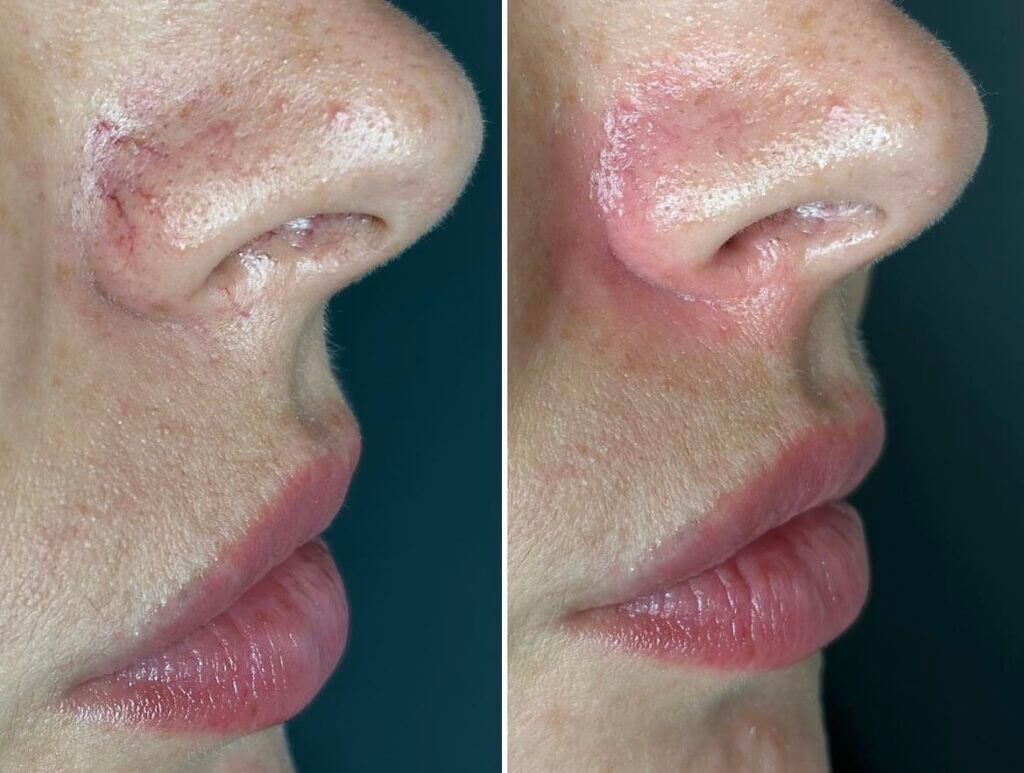 Antes y después de tratamiento Morpheus 88 en VenusMed