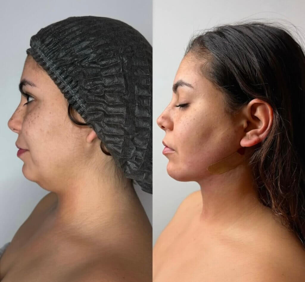 Antes y Después del tratamiento ENDOLIFT