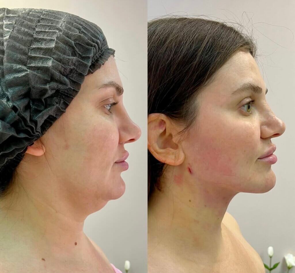 Antes y Después del tratamiento ENDOLIFT