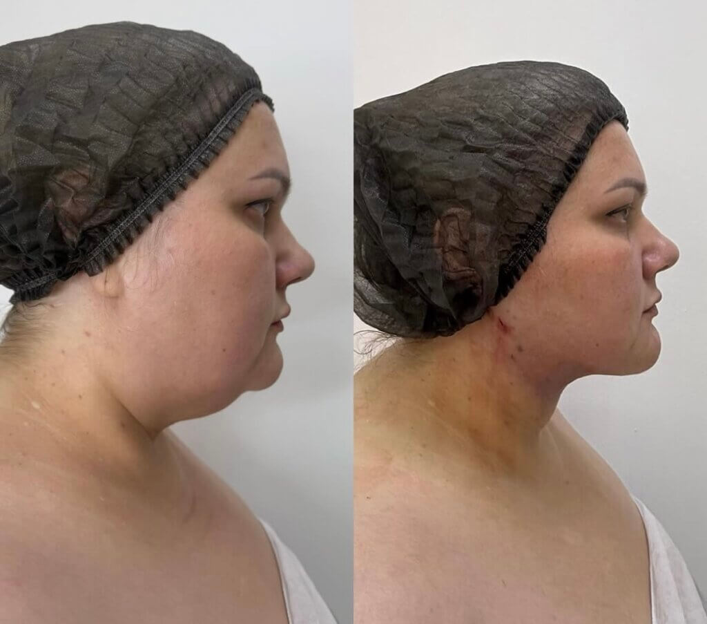 Antes y Después del tratamiento ENDOLIFT