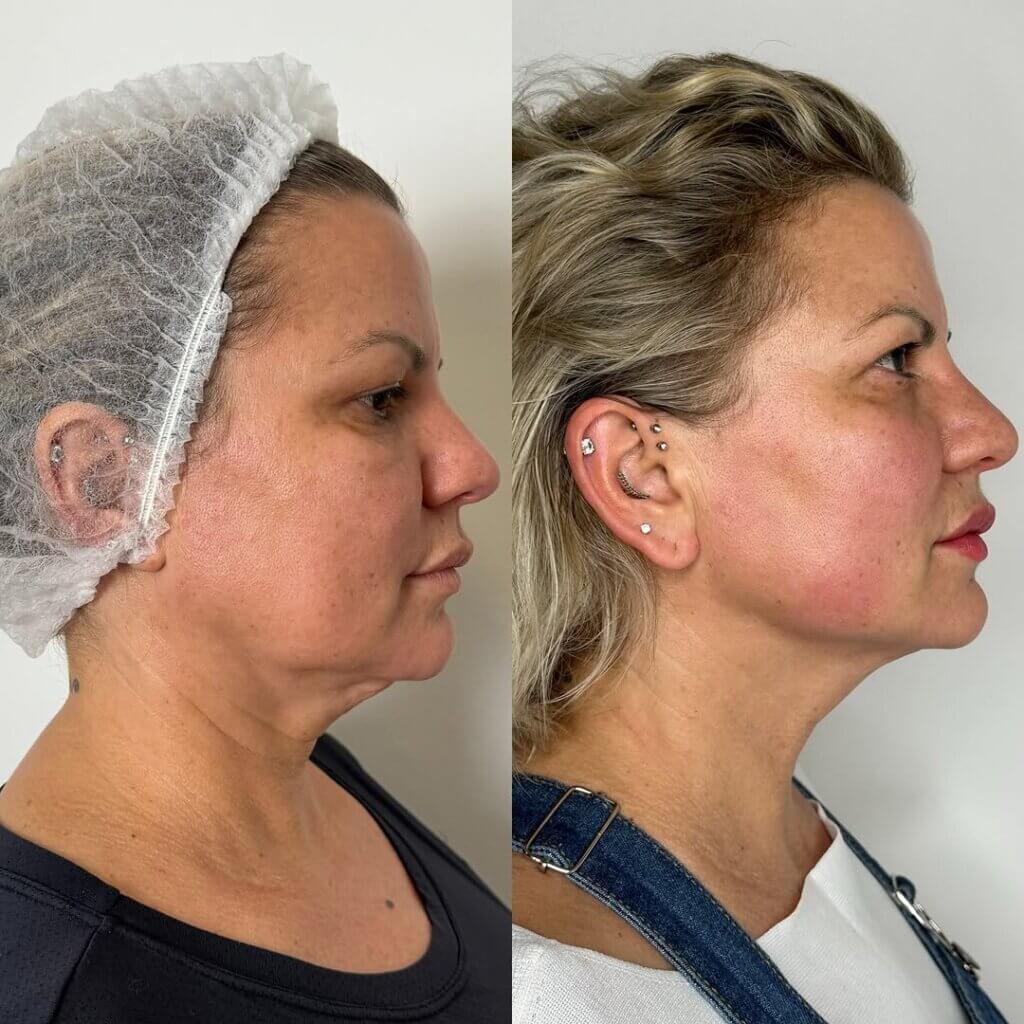 Antes y Después del tratamiento ENDOLIFT