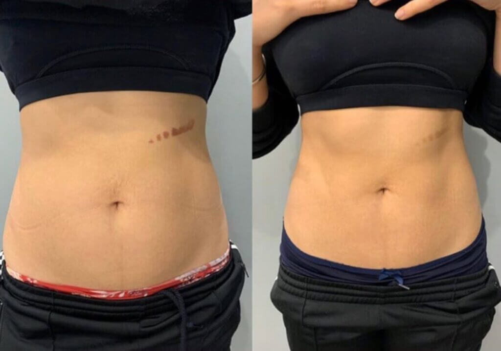 Resultados visibles con BodyFX: piel más firme y contorno definido