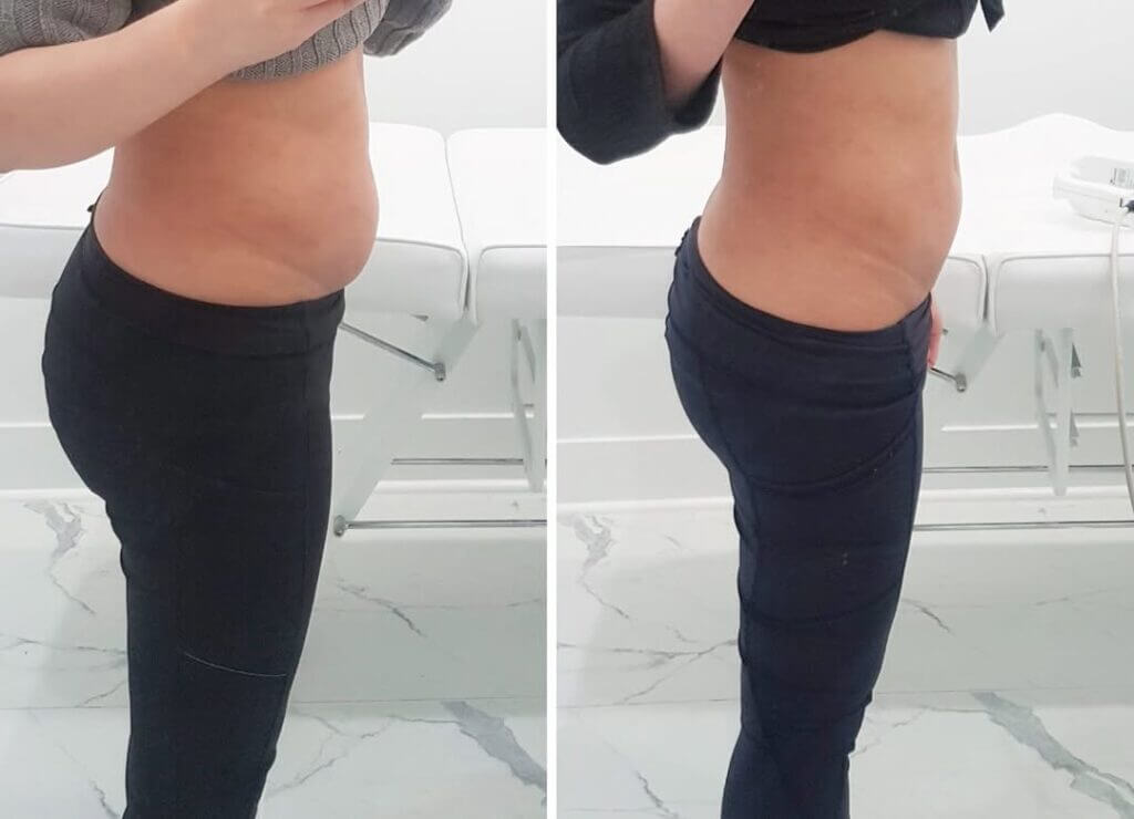 Antes y después de tratamiento BodyFX para reducción corporal en VenusMed