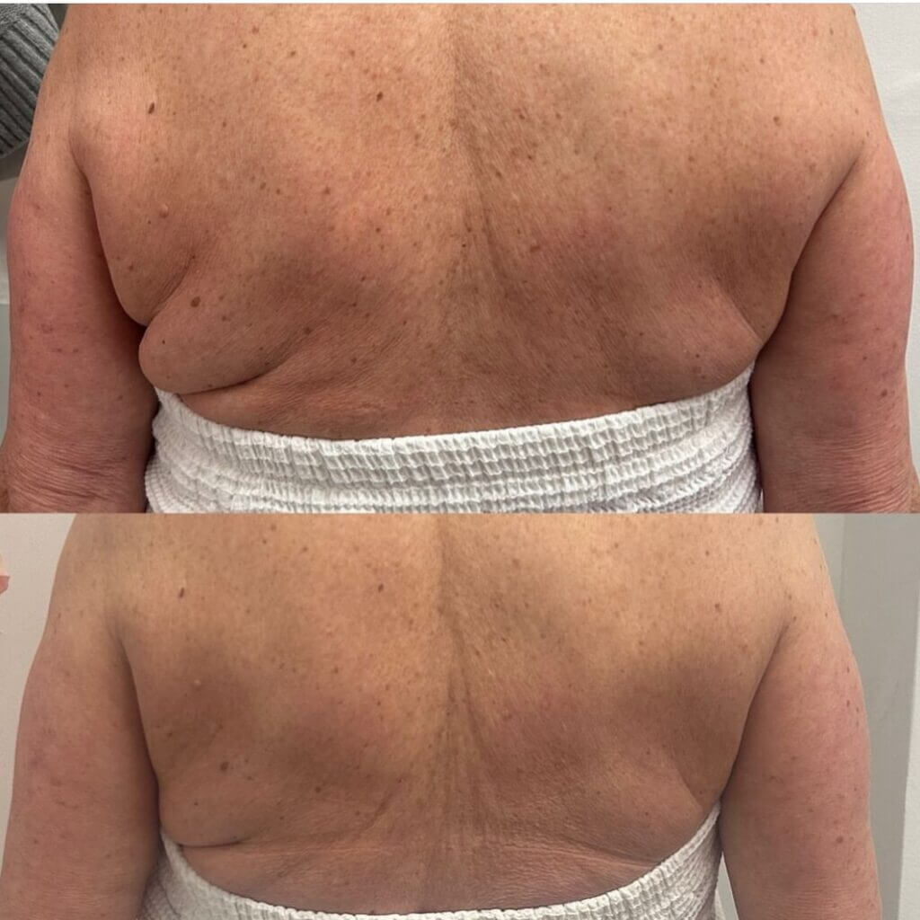 Antes y después de tratamiento facial con Lifting facial sin relleno en VenusMed