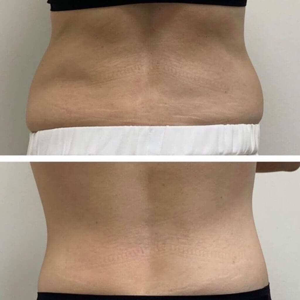 Antes y después de tratamiento Body FX en VenusMed