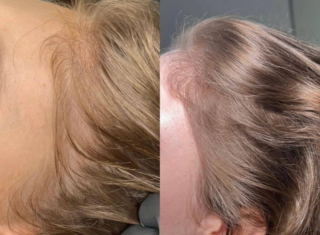 ANTES Y DESPUÉS de Tratamiento capilar