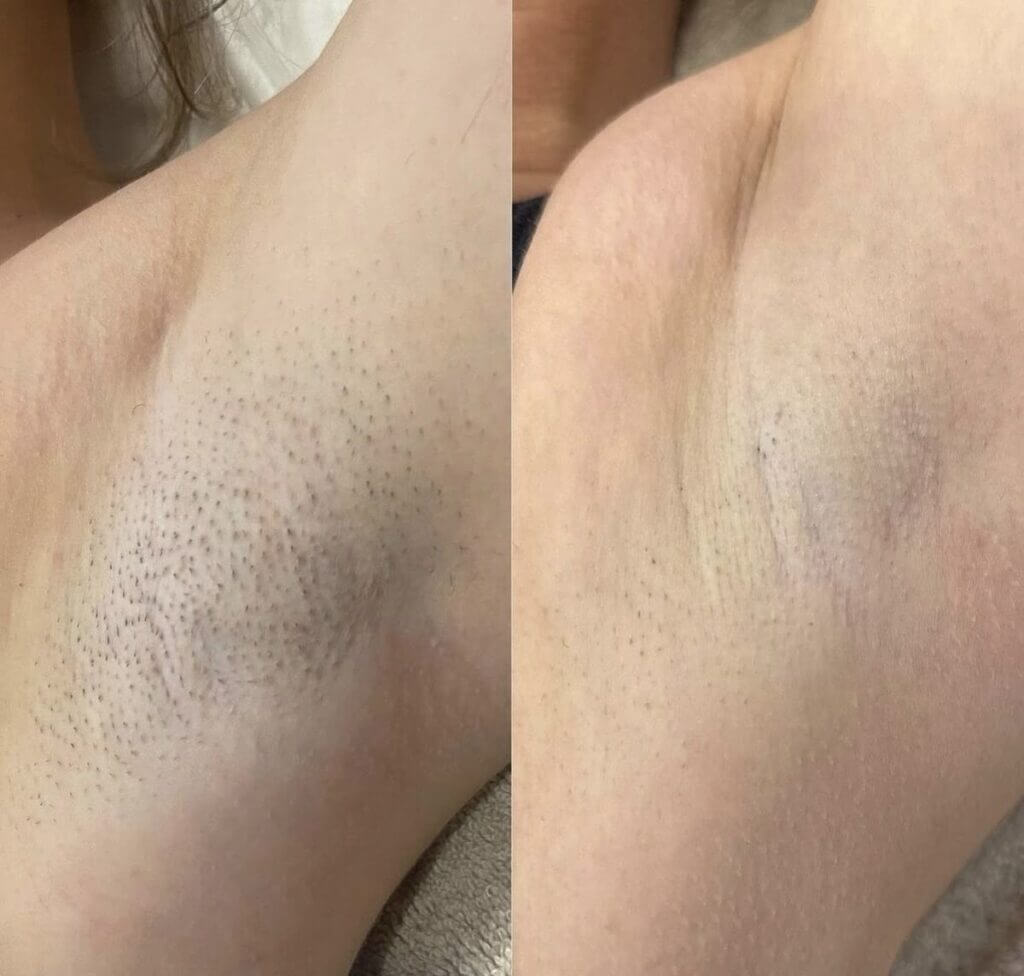 Tratamiento Endolift en Madrid en VenusMed